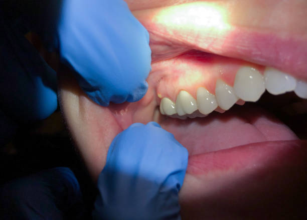 Best Broken or Cracked Tooth Emergency Dentist in Front Royal, VA